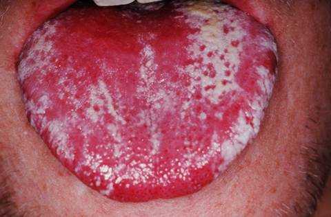 Diagnosis And Treatment For Tongue Lesions